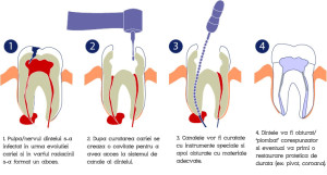 tratament-de-canal02